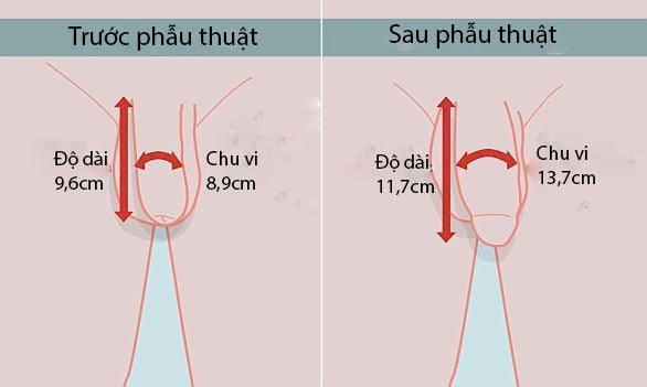 Dịch vụ cấy ghép chất liệu vào dương vật