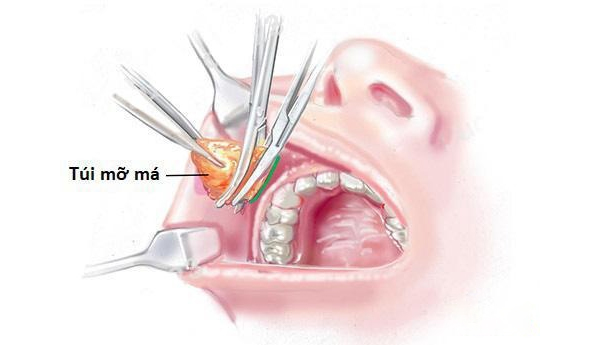 Quy trình thực hiện hút mỡ má an toàn, chuyên nghiệp