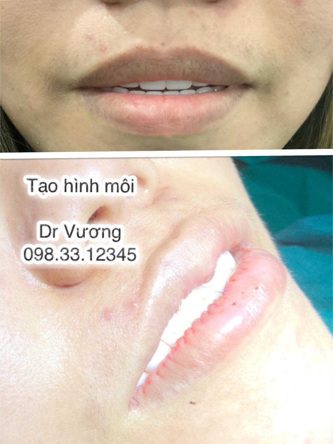 hình ảnh khách hàng tạo hình môi tại dr vương